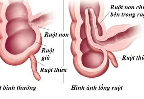 Lồng ruột là bệnh gì