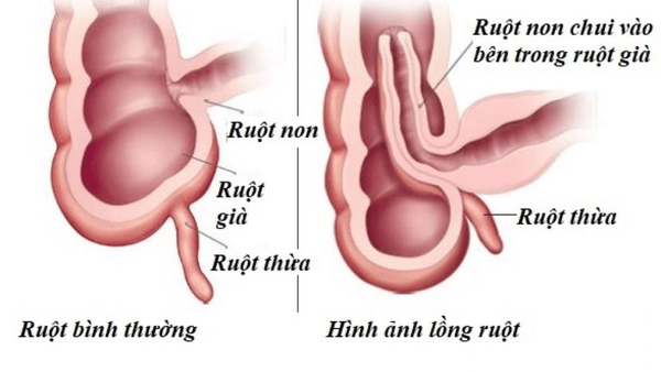 Lồng ruột là bệnh gì